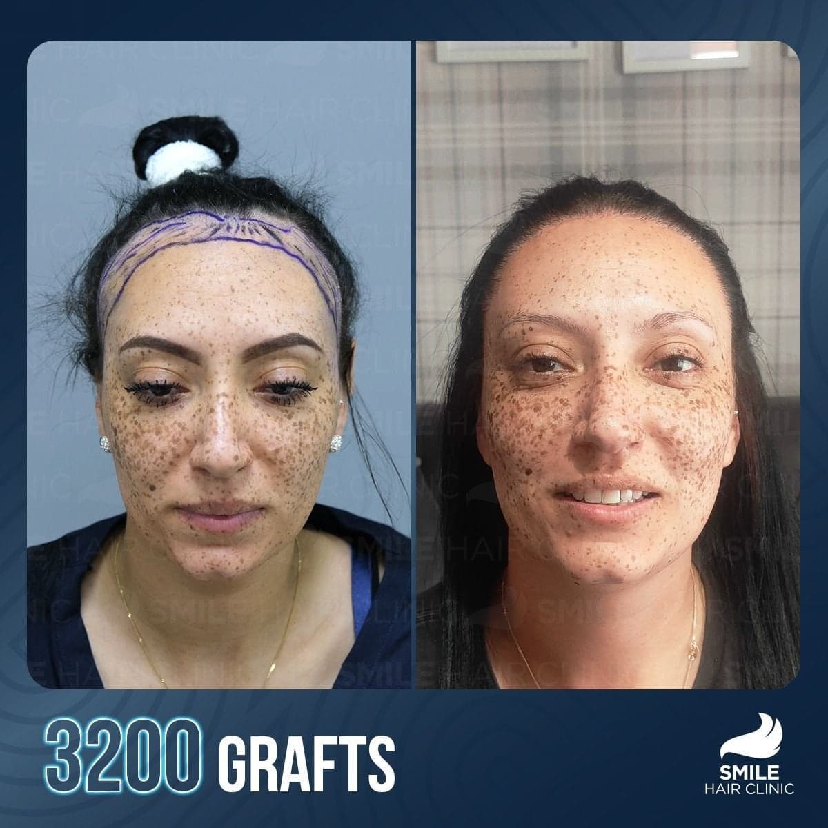 result, 3200 grafts