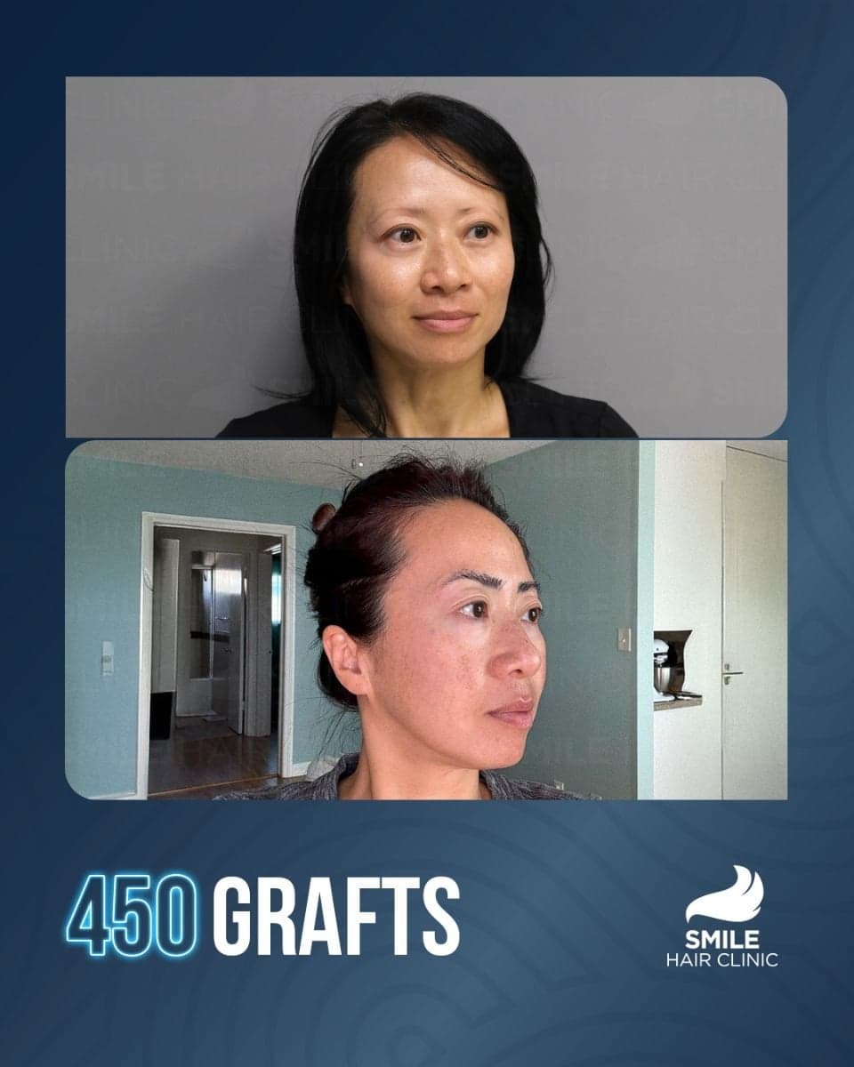 eyebrow transplant