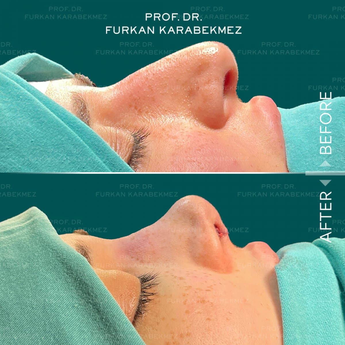 rhinoplasty