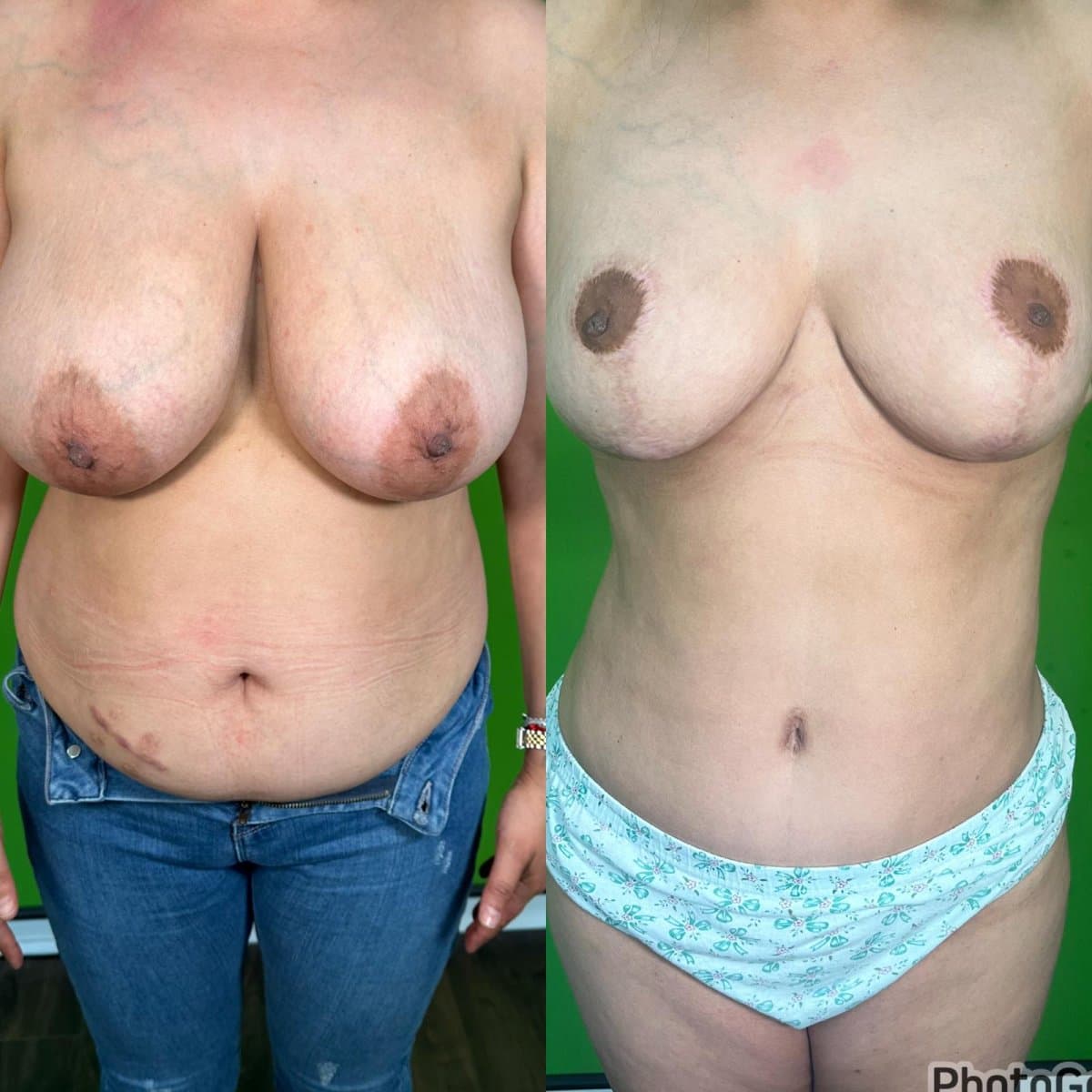 tummy tuck and breast lift