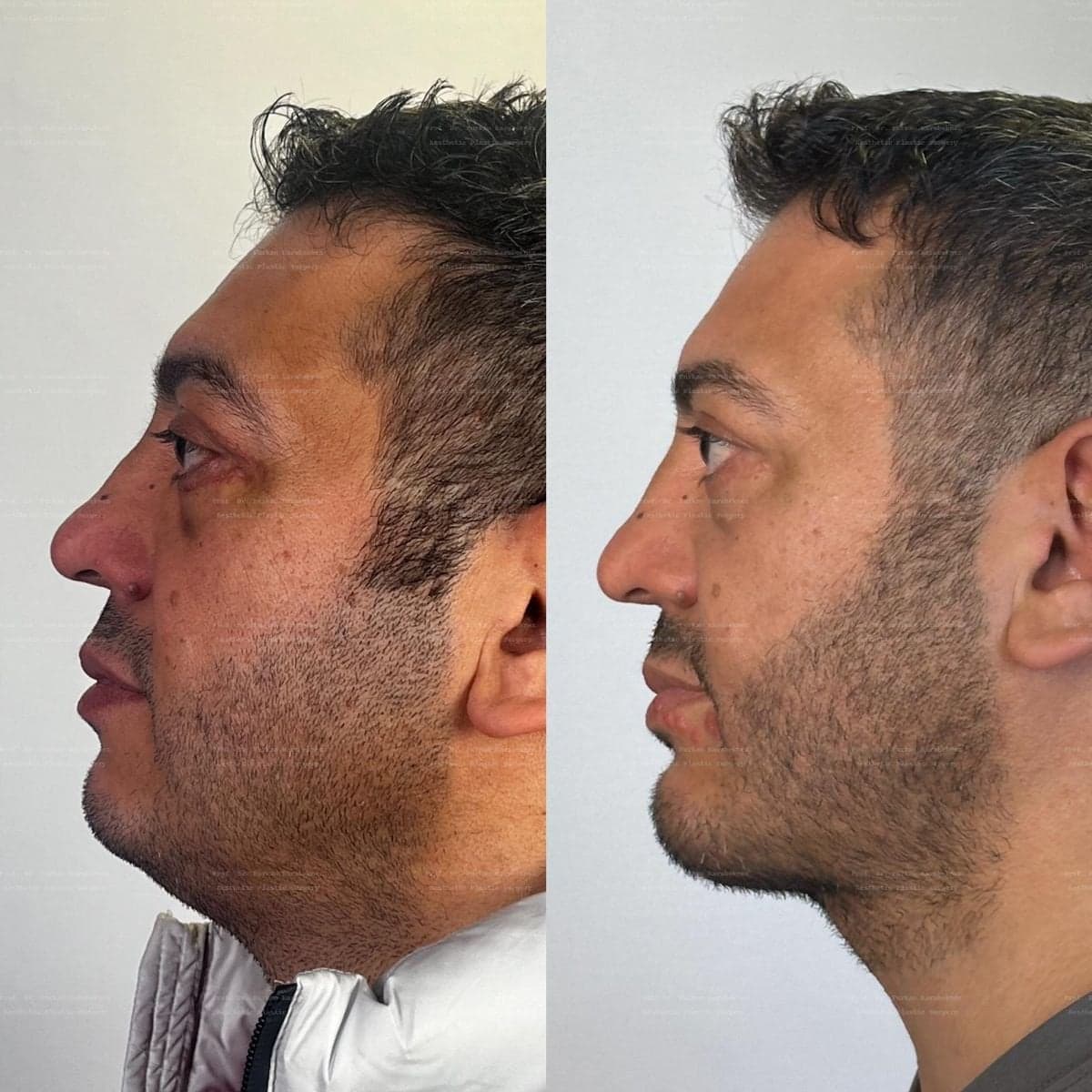 chin implant