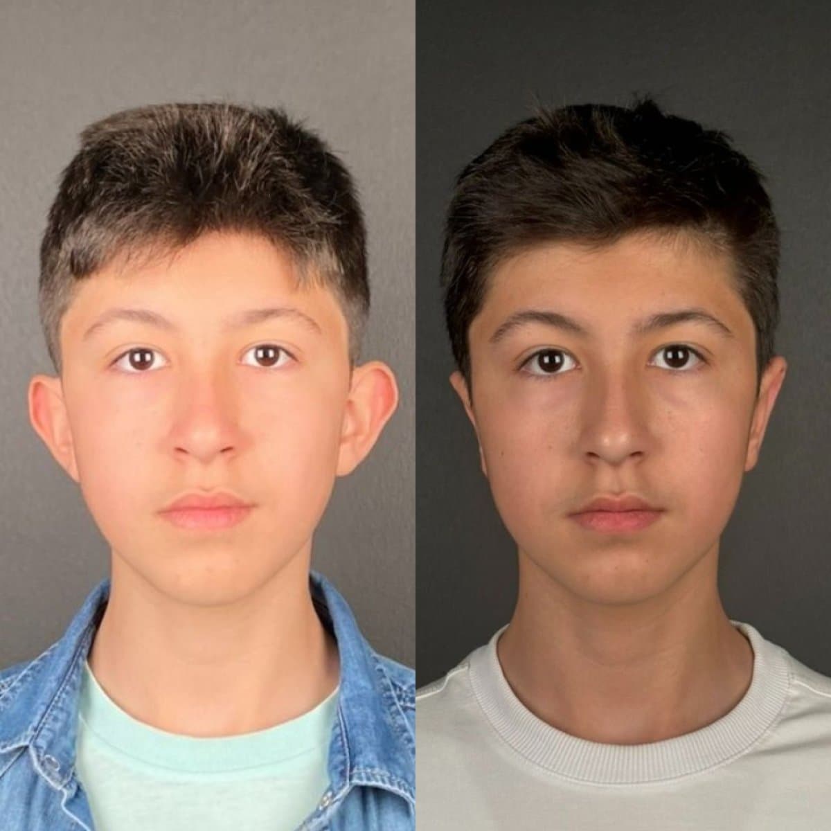 otoplasty