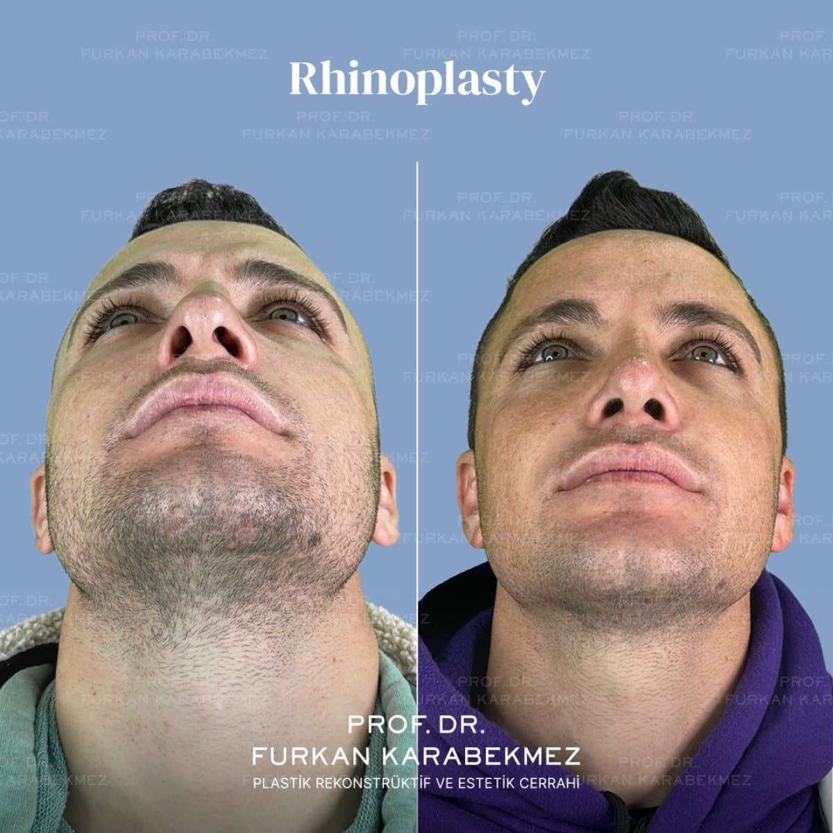 rhinoplasty