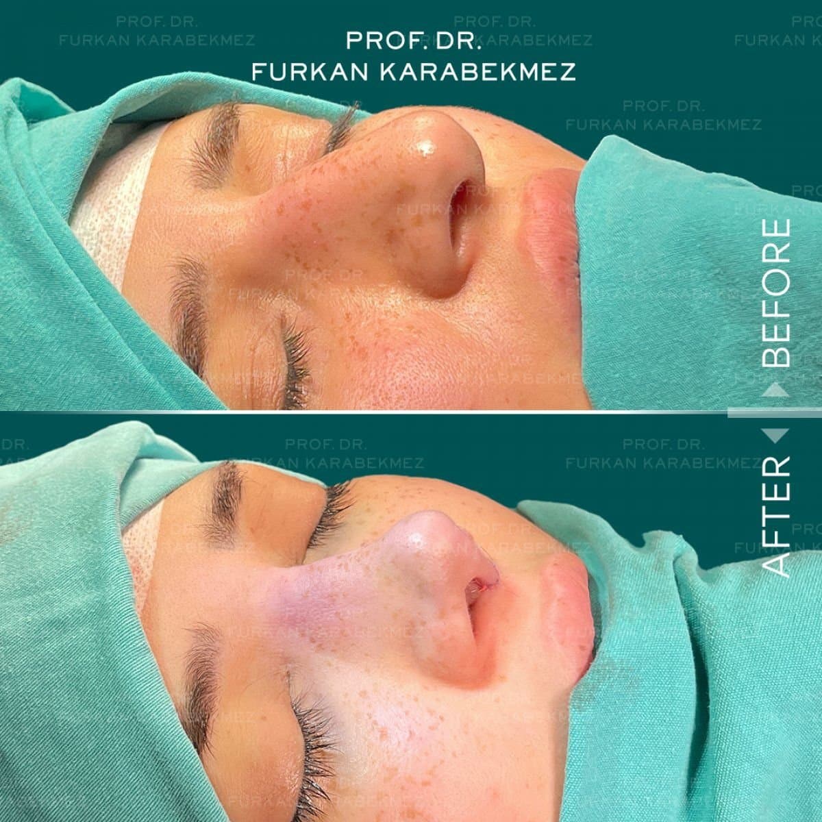 rhinoplasty