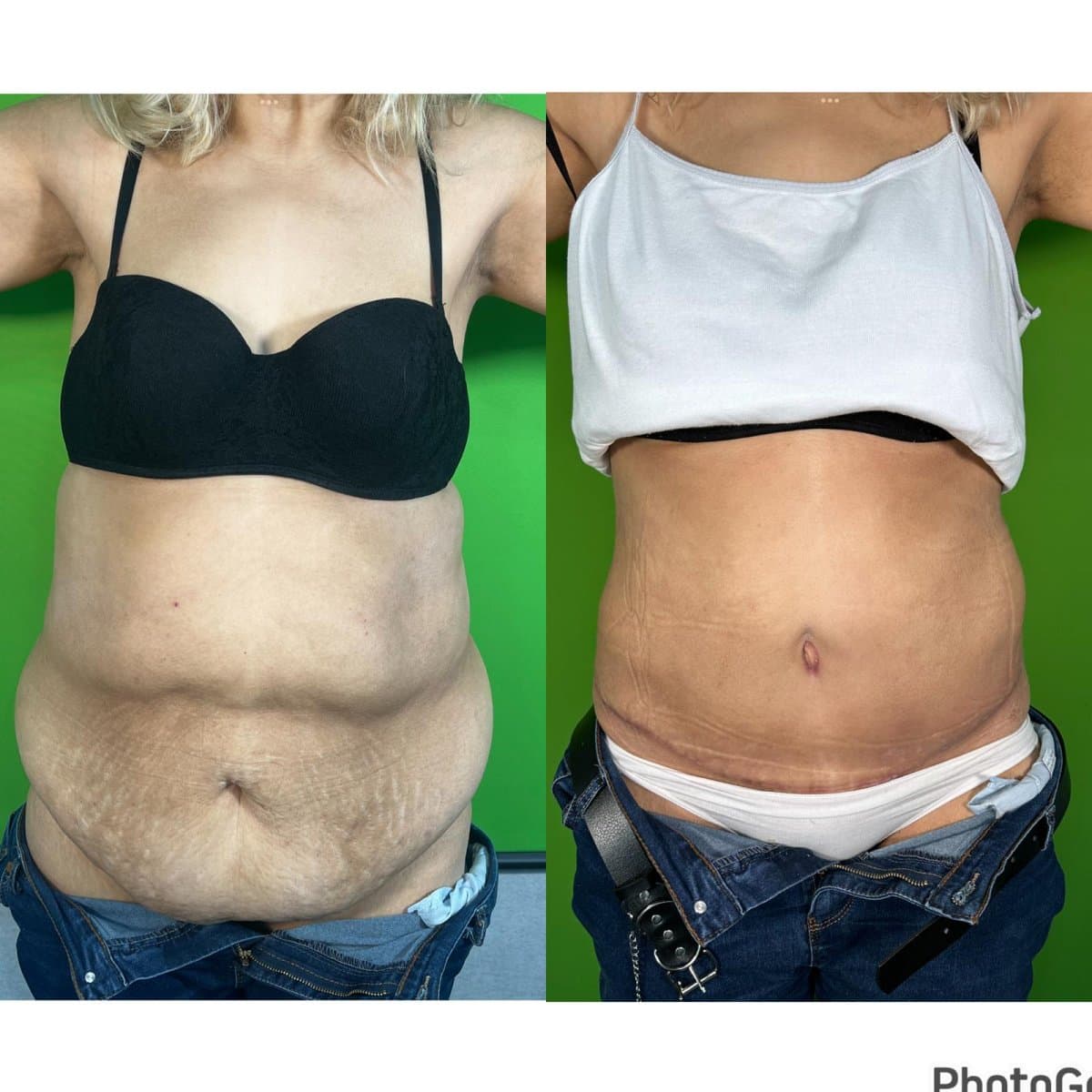 tummy tuck