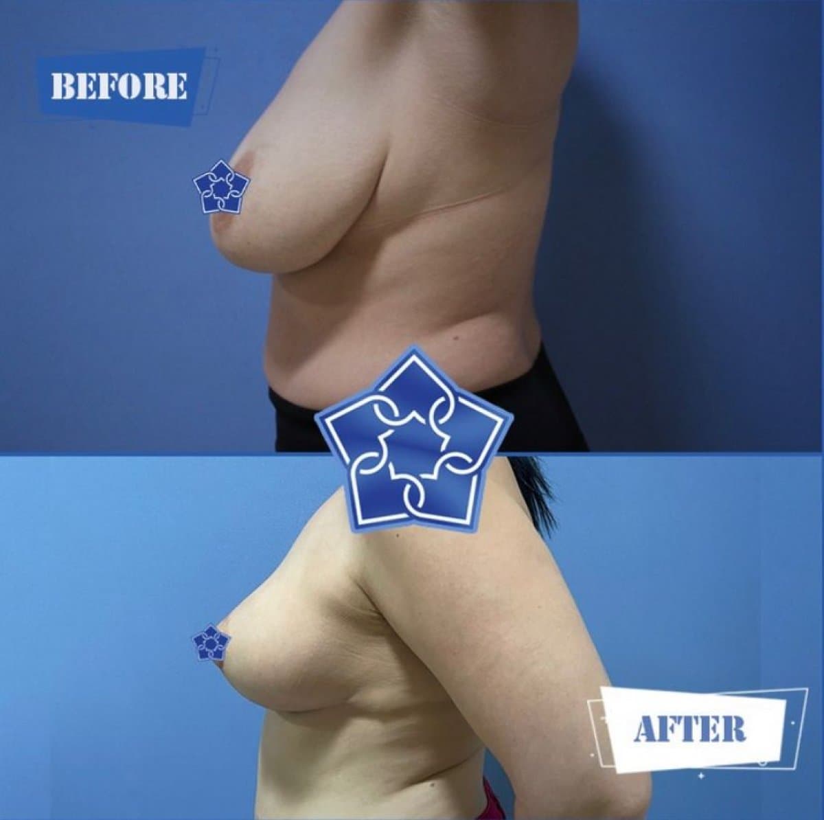 breast lift