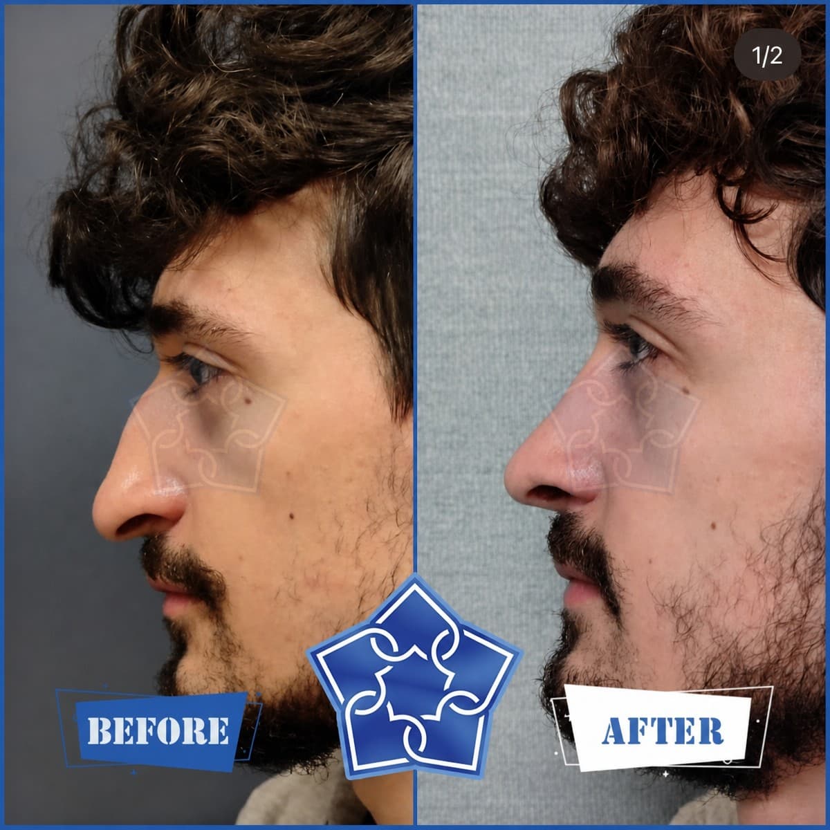 rhinoplasty