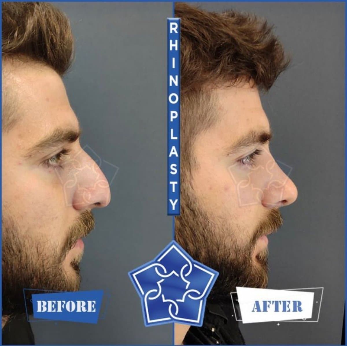 rhinoplasty