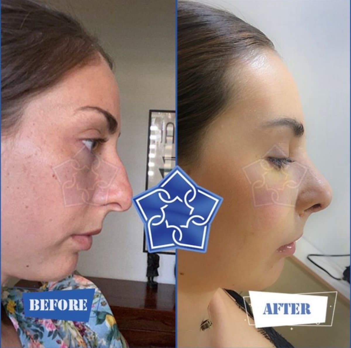 rhinoplasty