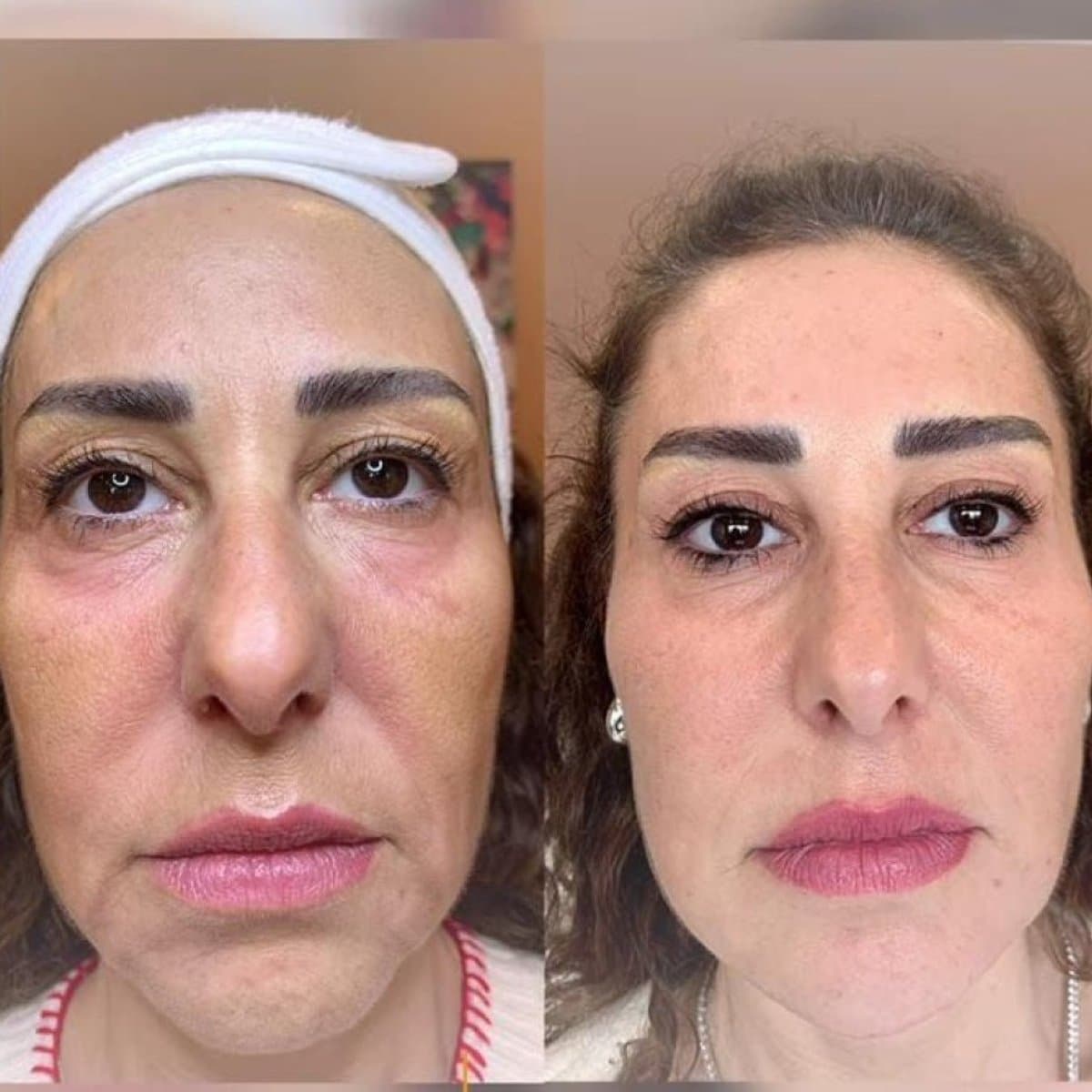 Morpheus8 skin tightening