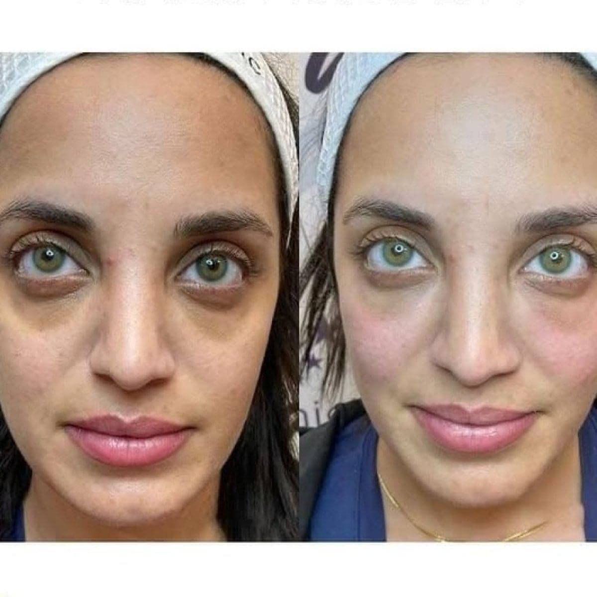 Morpheus8 skin tightening