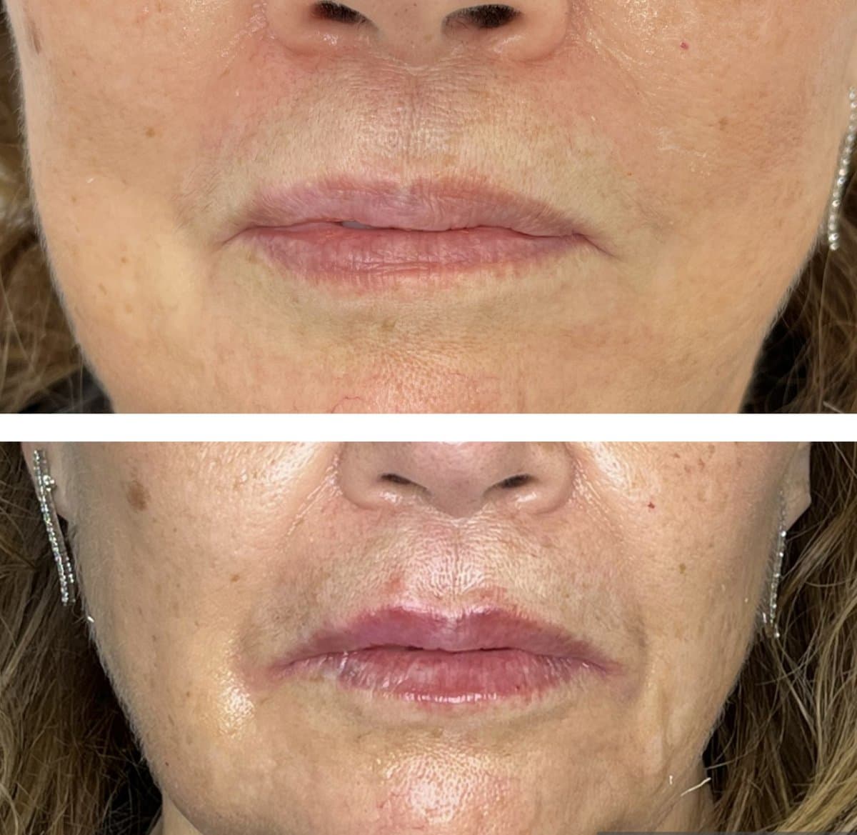 lip lift