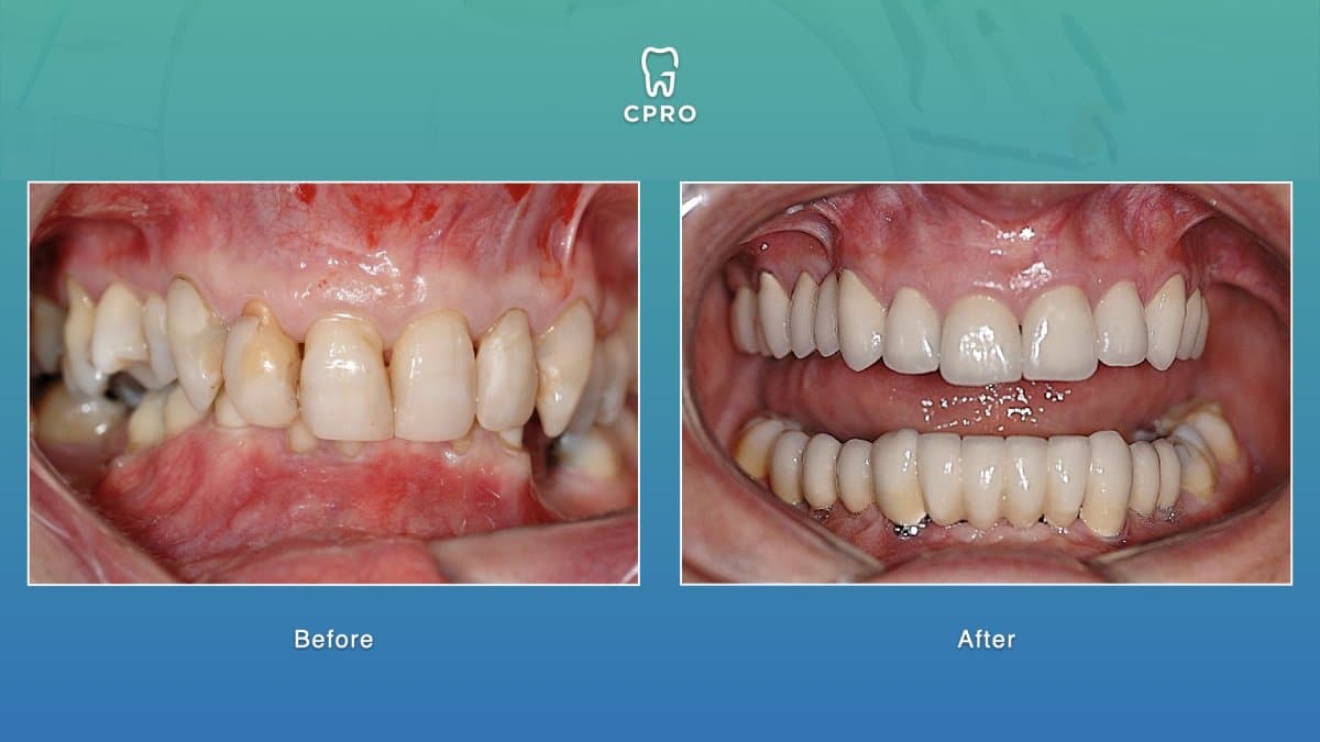 dental crown installation