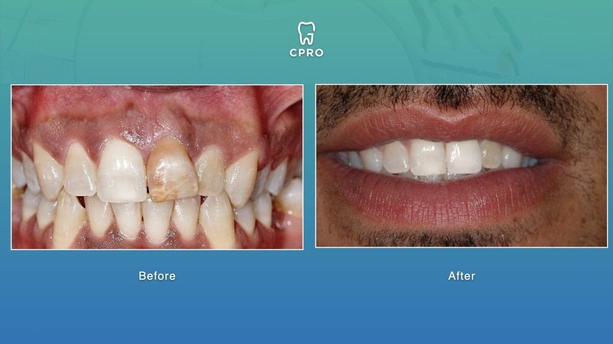 porcelain veneer