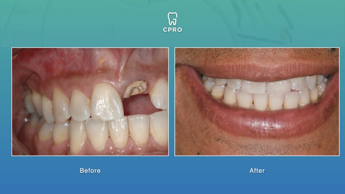 dental crown installation