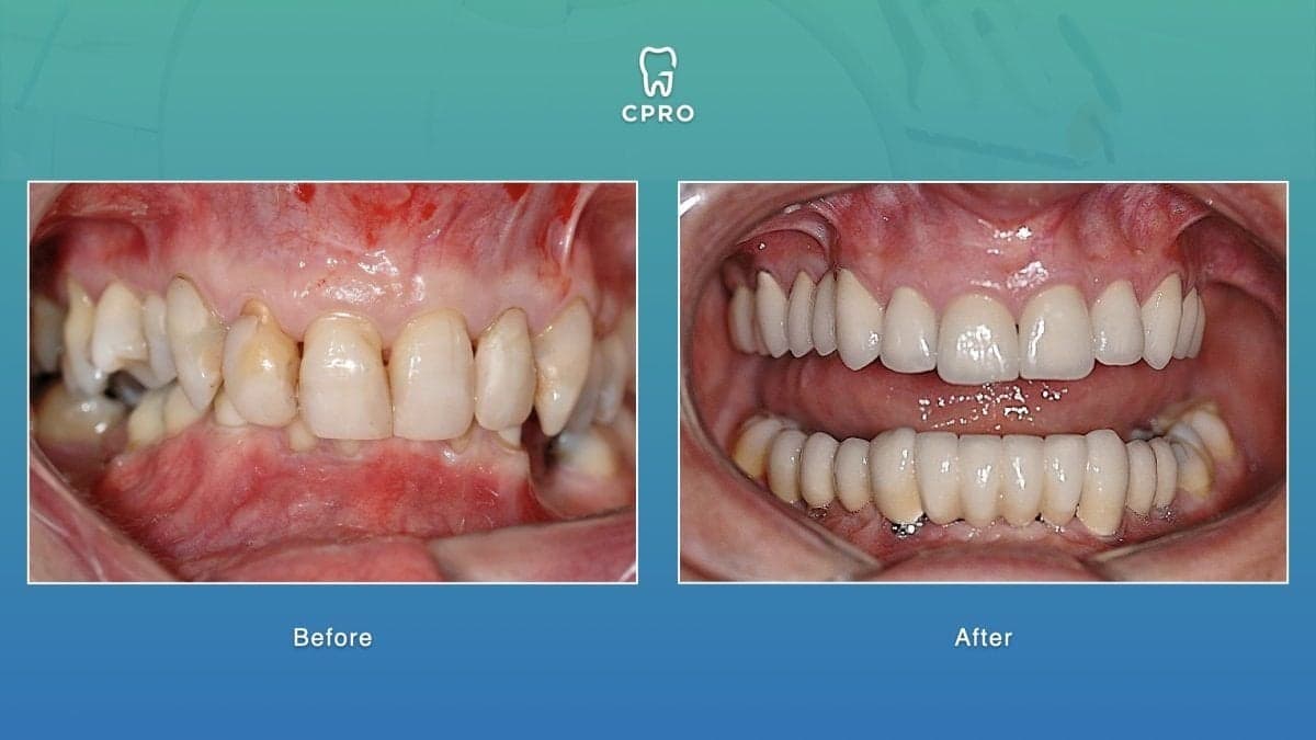 porcelain veneer