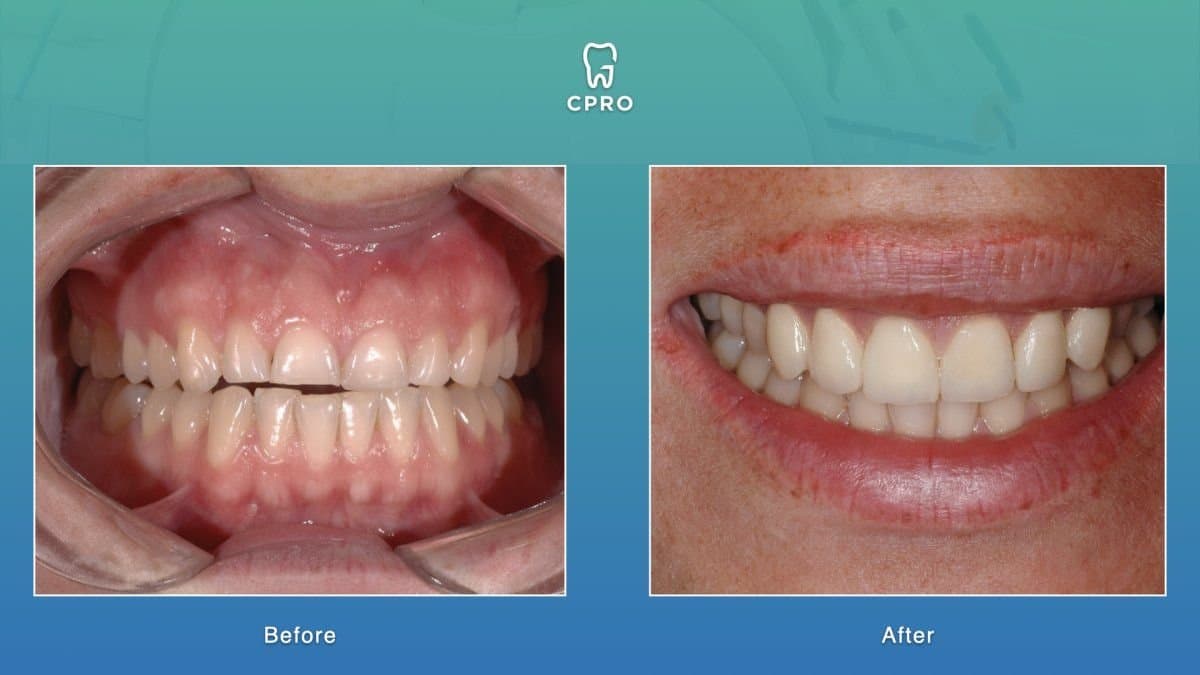 porcelain veneer