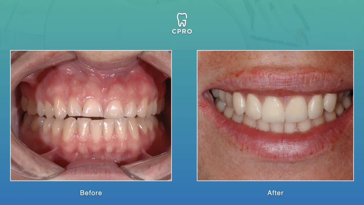 dental crown installation