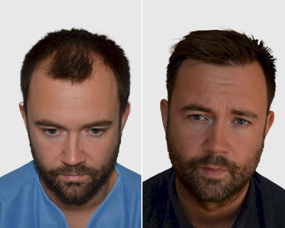 hair transplant
