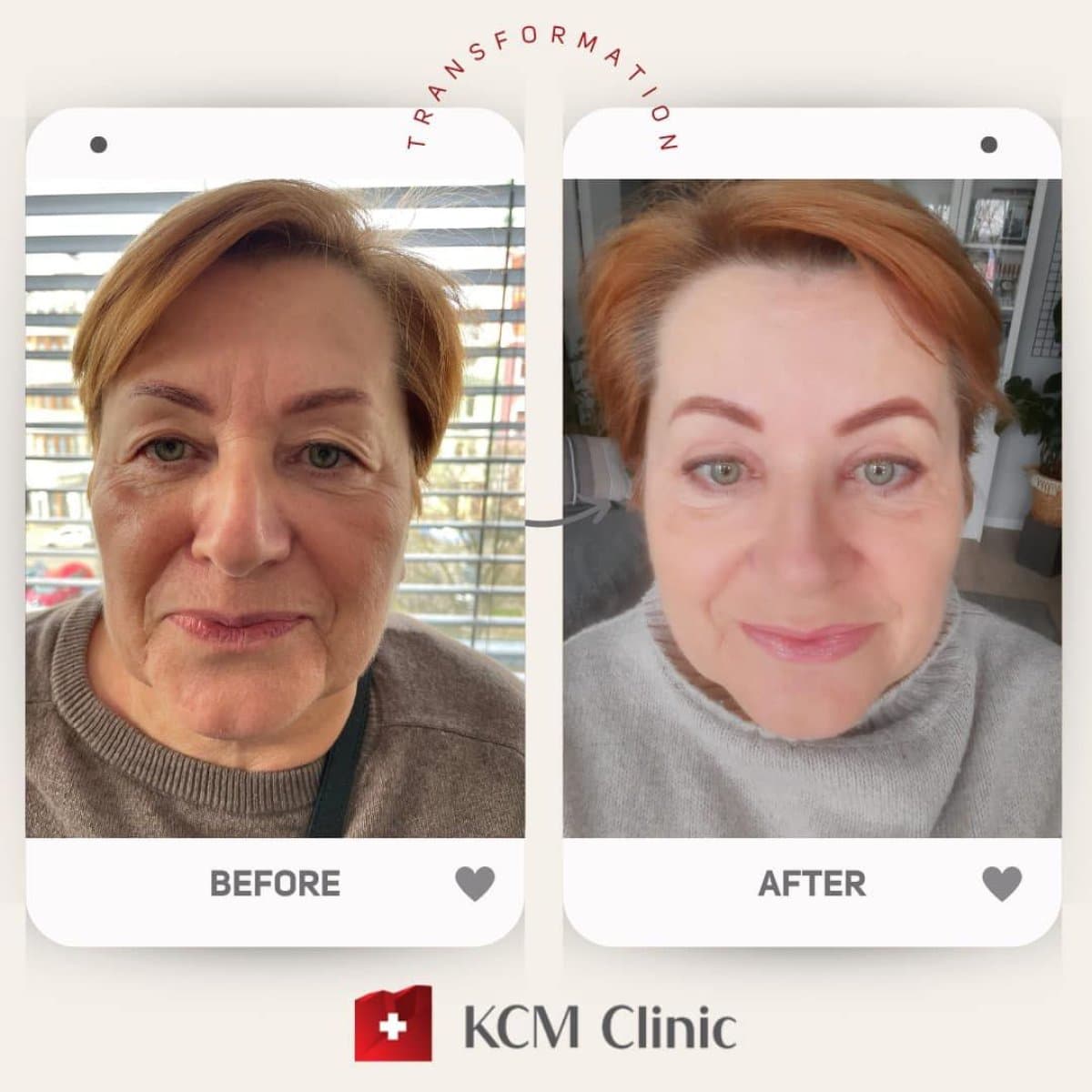 neck lift
