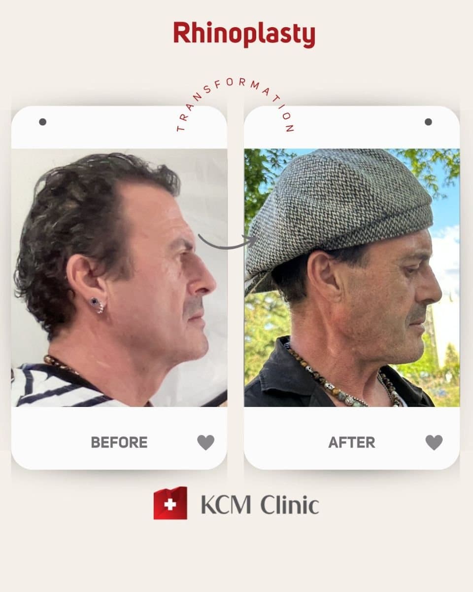 rhinoplasty