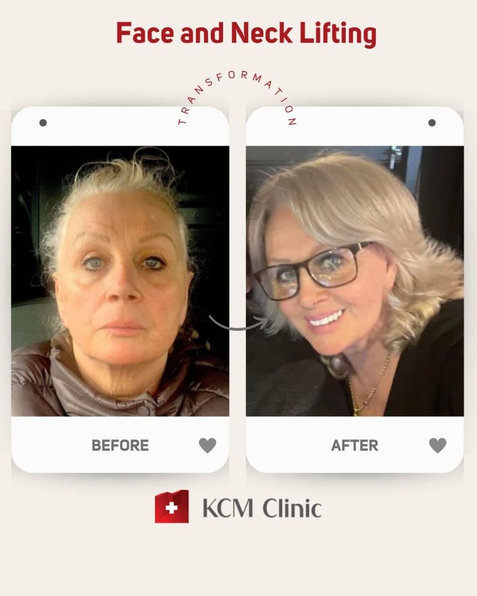 neck lift