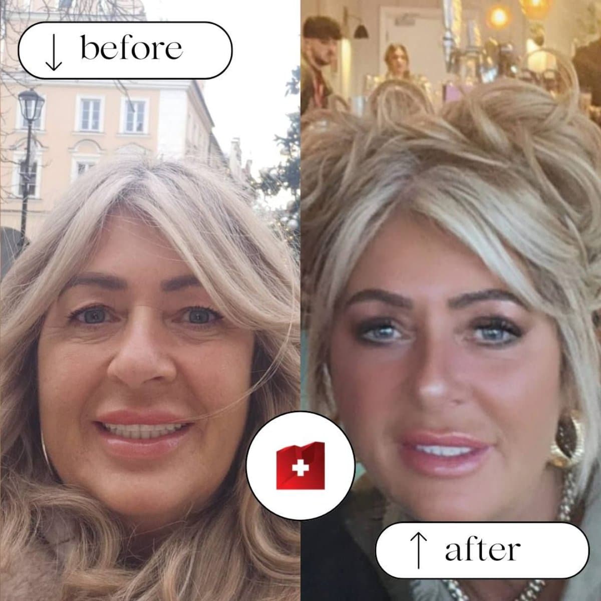 neck lift