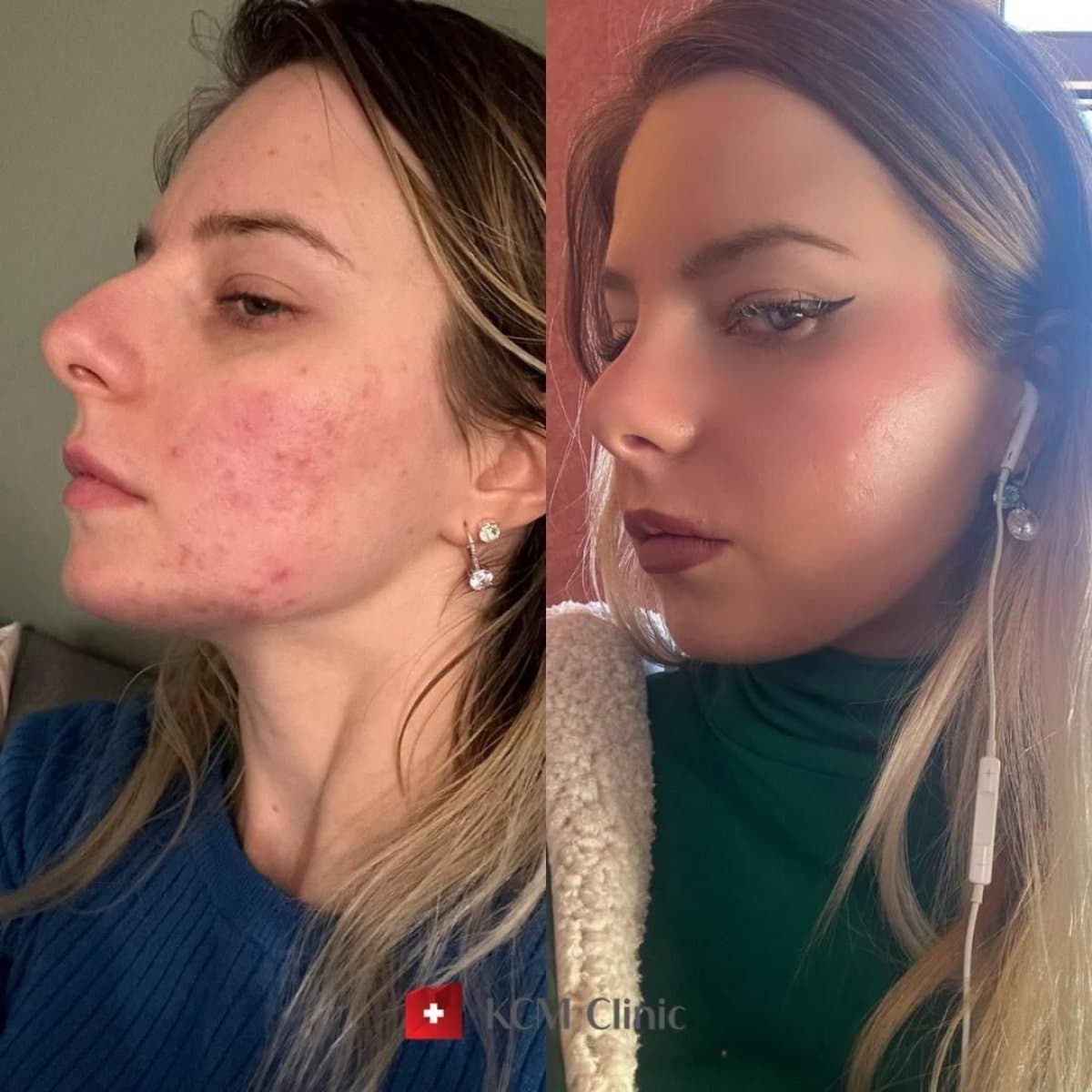 acne treatment