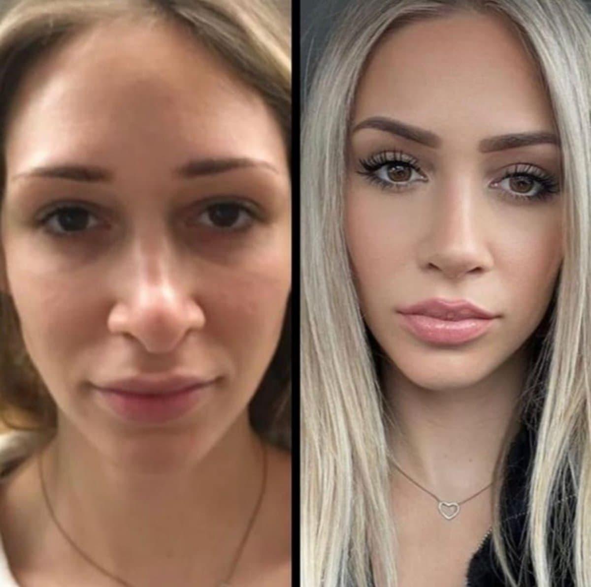 rhinoplasty