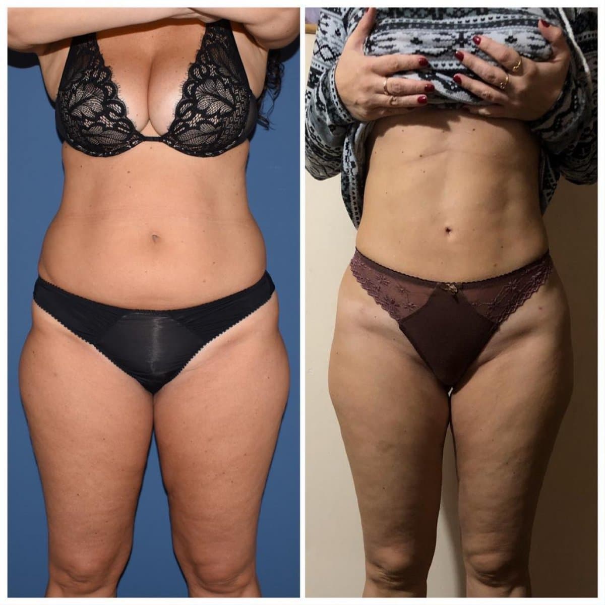liposuction