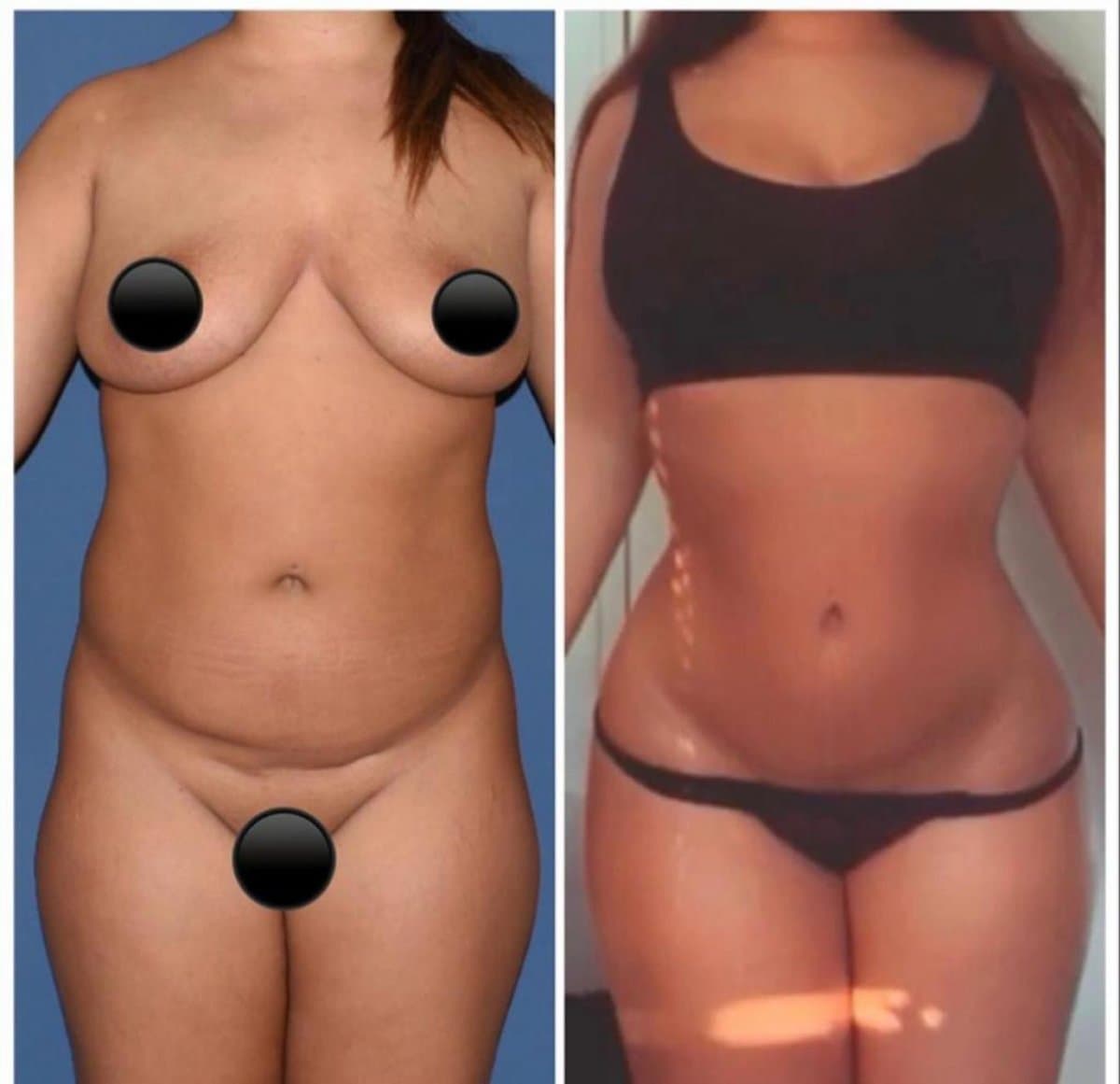 Brazilian Butt Lift
