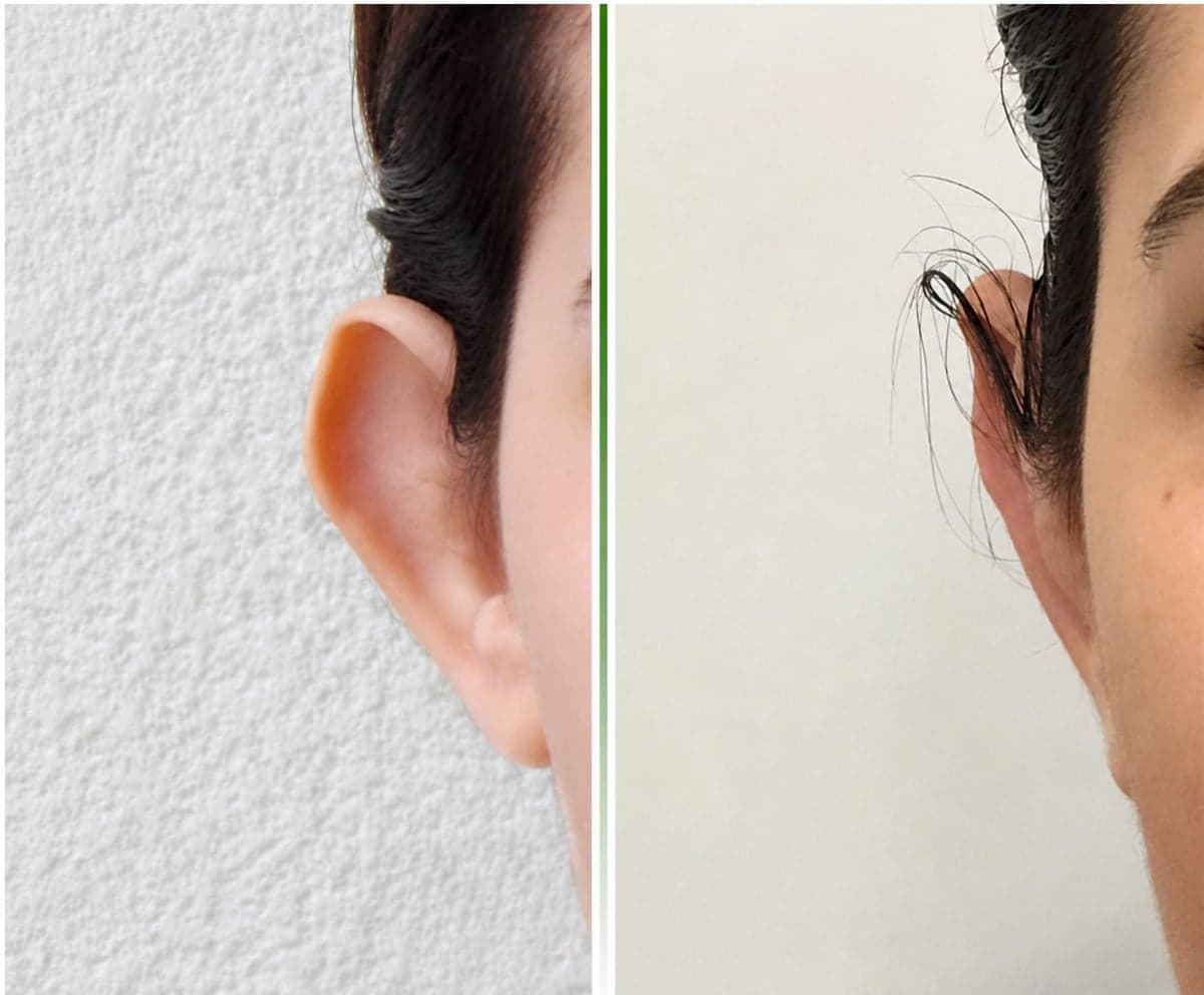 otoplasty