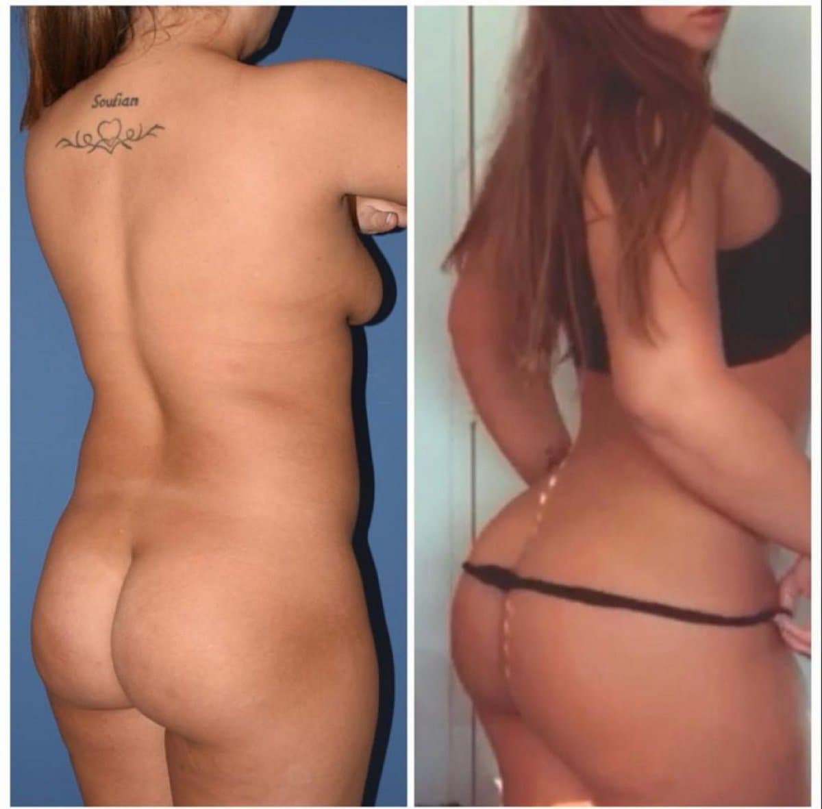 Brazilian Butt Lift