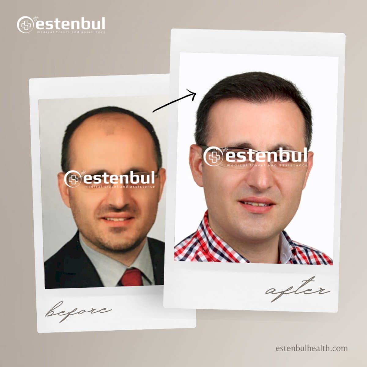 FUE hair transplant