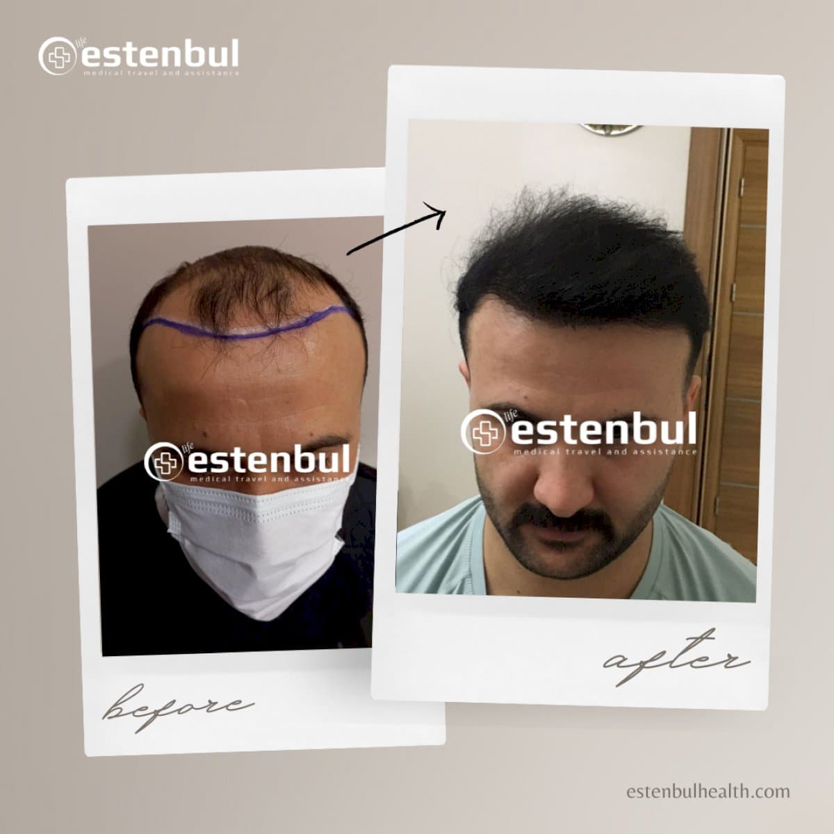 hair transplant