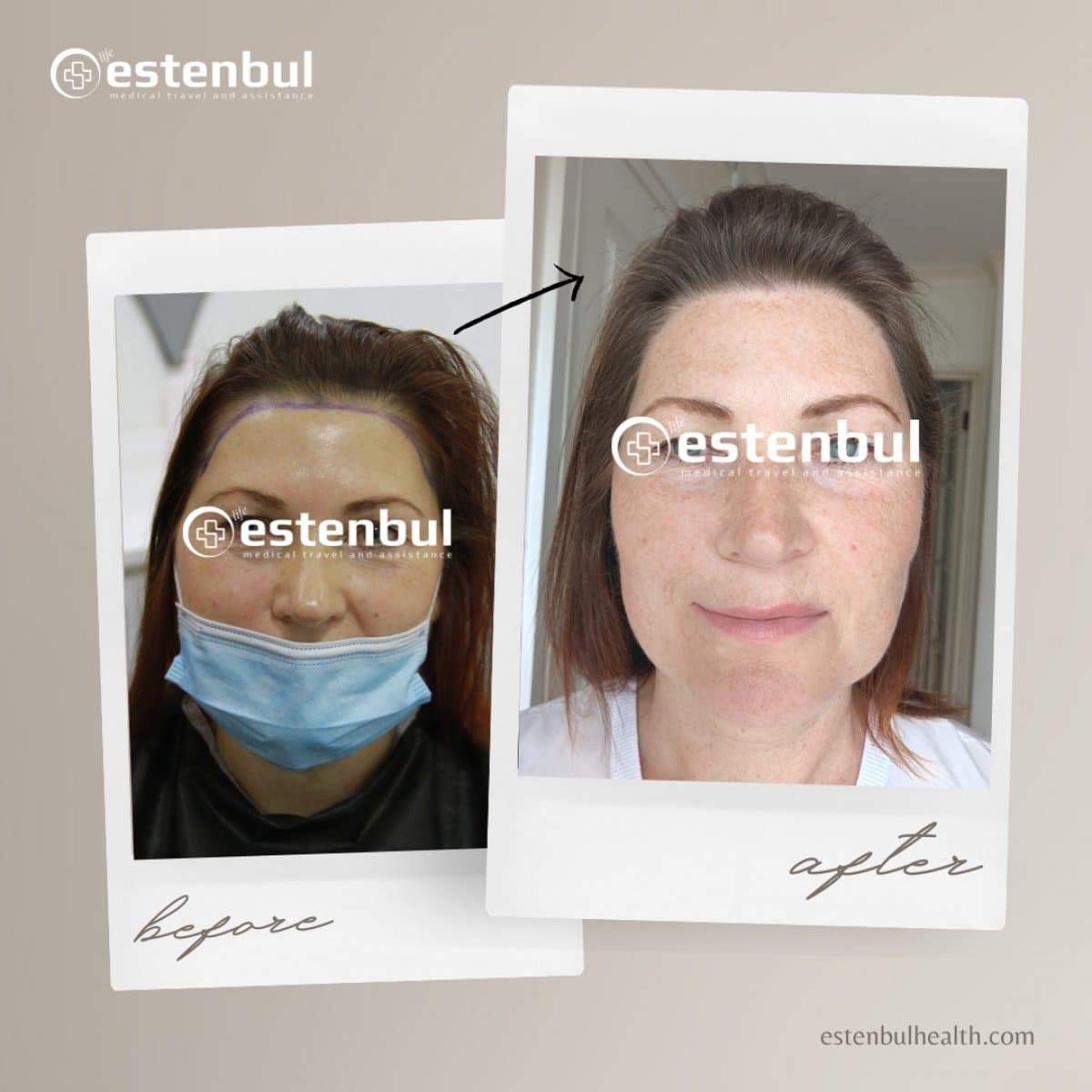 FUE hair transplant