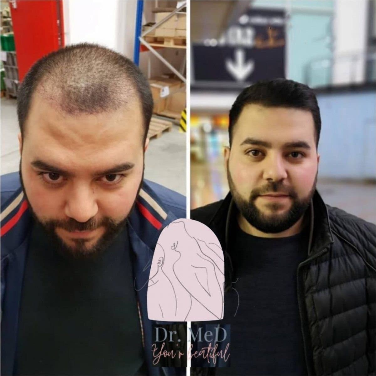 hair transplant