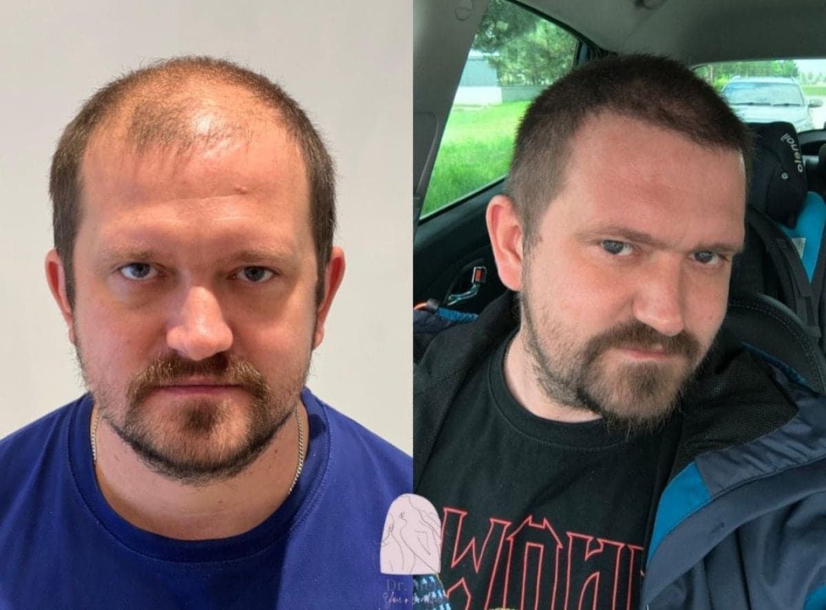 FUE hair transplant