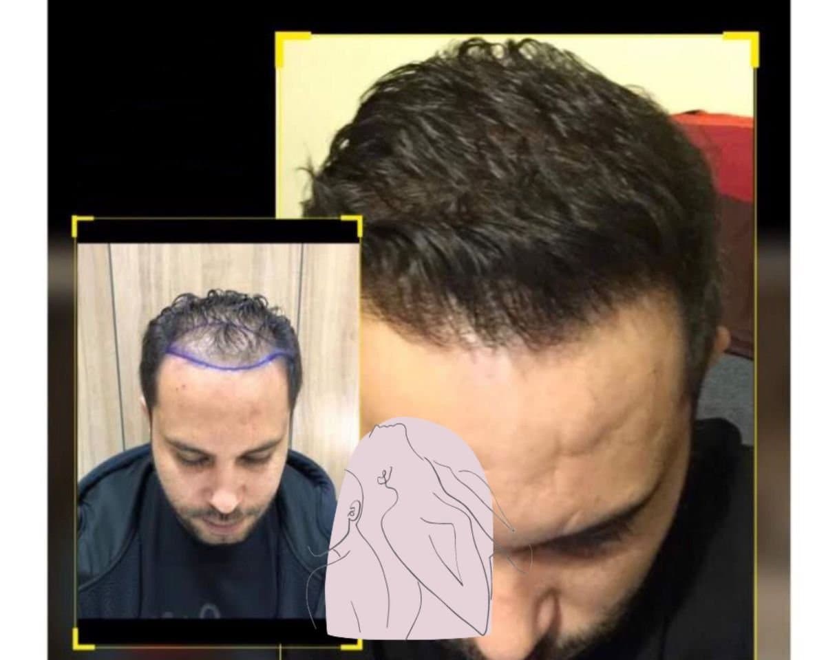 hair transplant