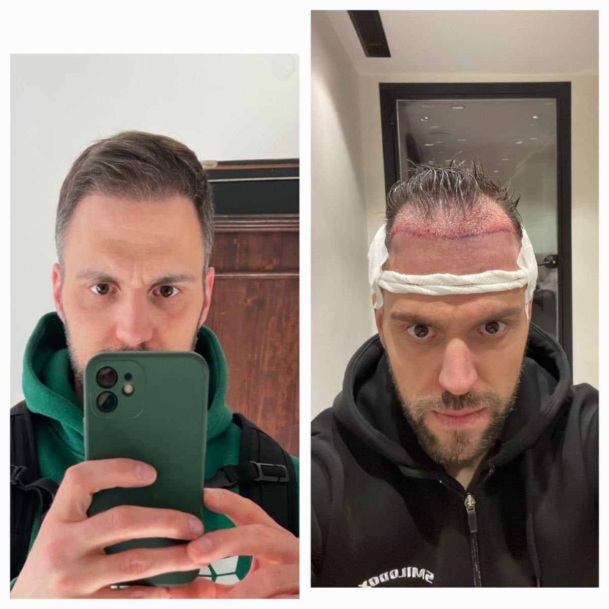 FUE hair transplant