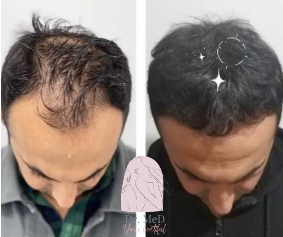 hair transplant