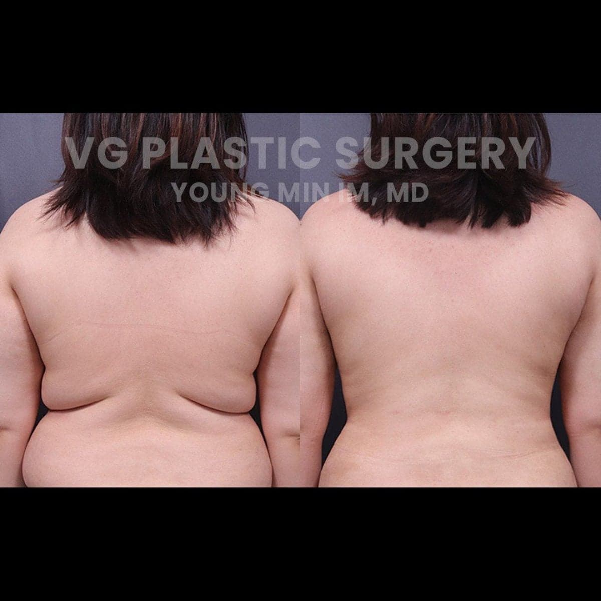 360 liposuction