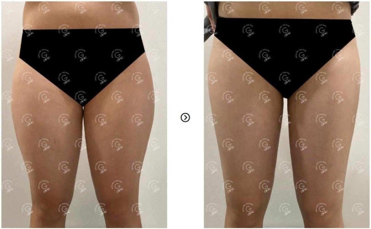 liposuction