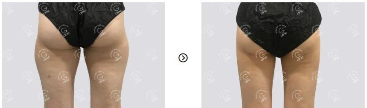 liposuction