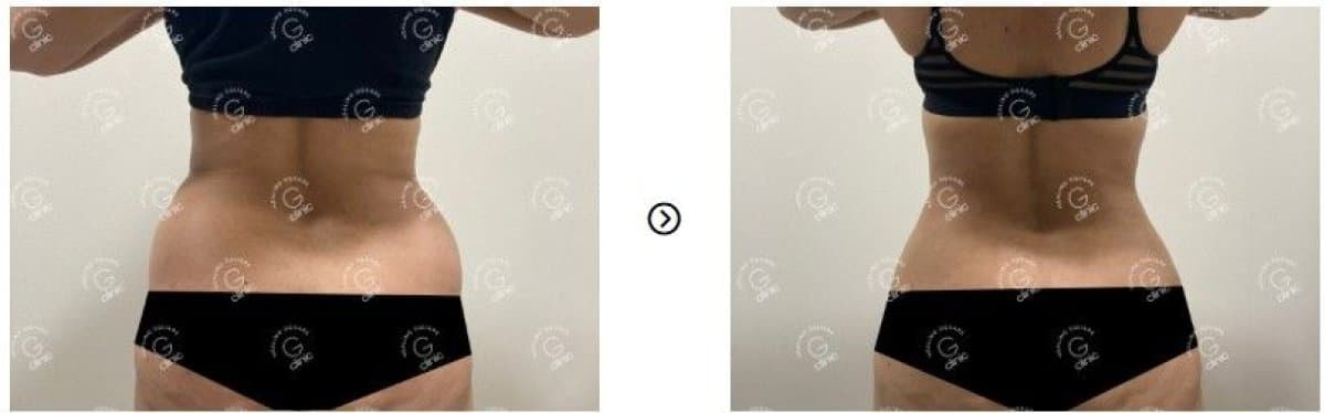 liposuction