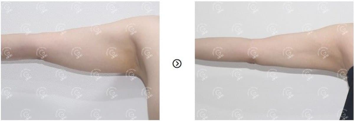 arm liposuction