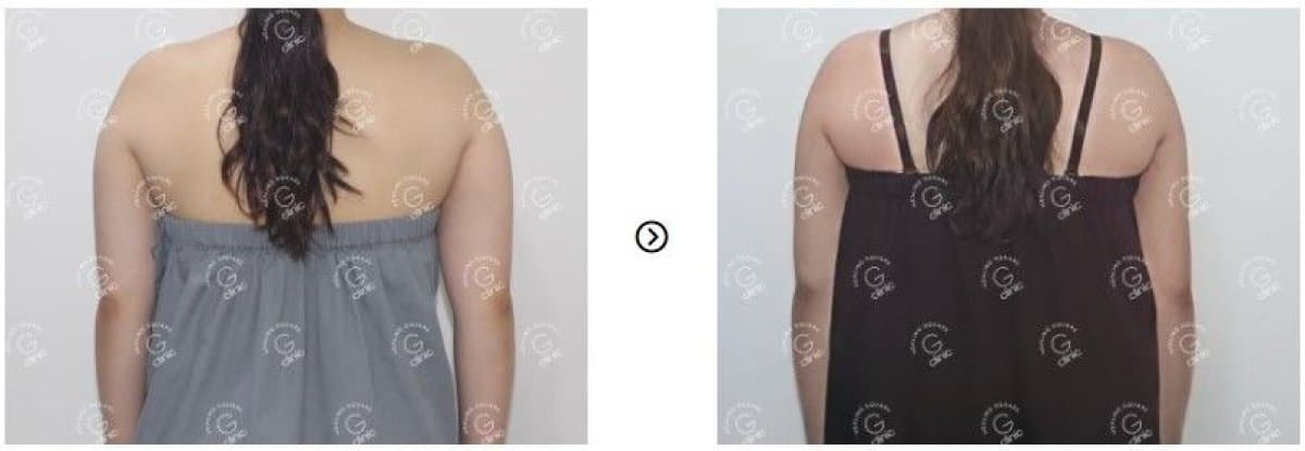 liposuction