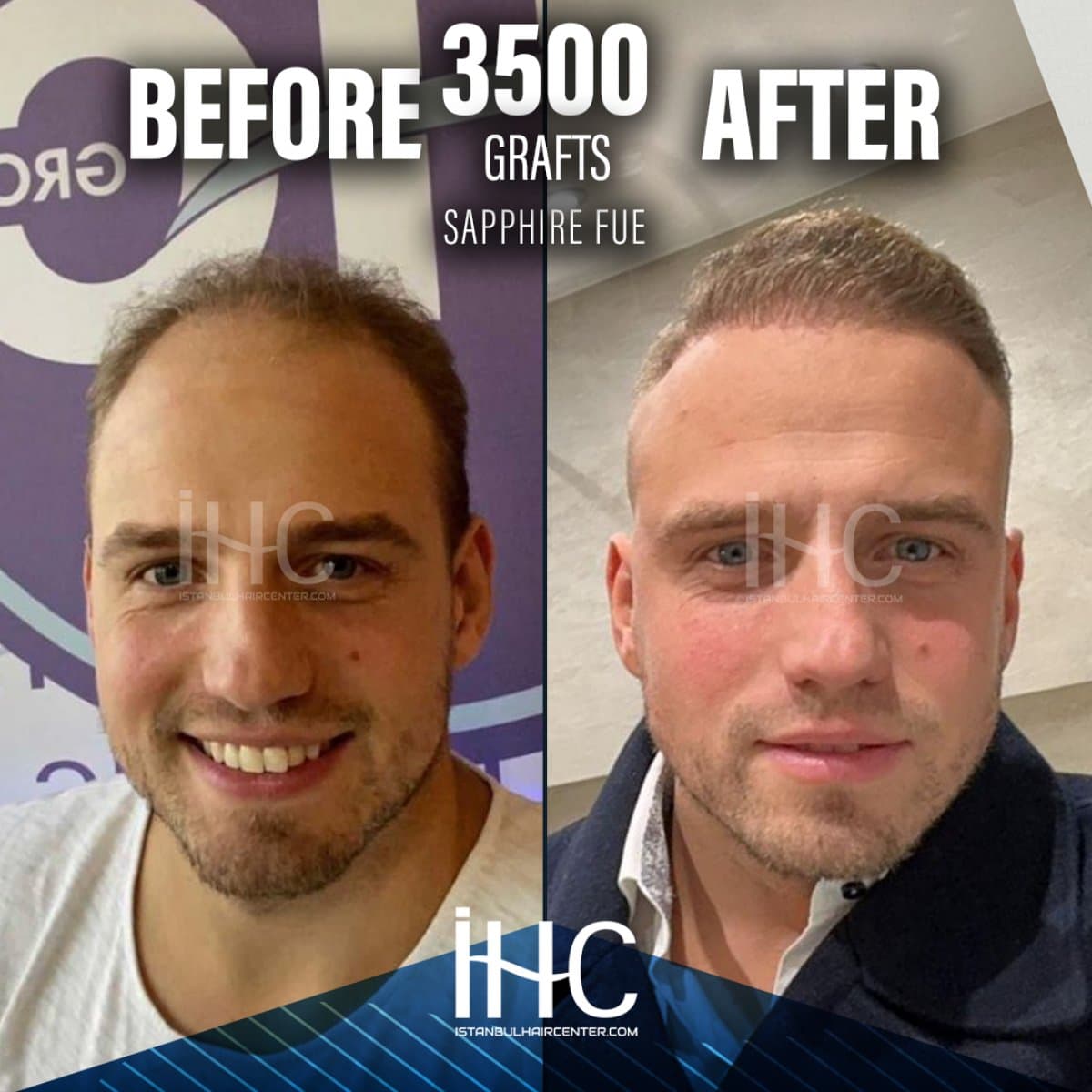 result of 3500 grafts Sapphire FUE hair transplant