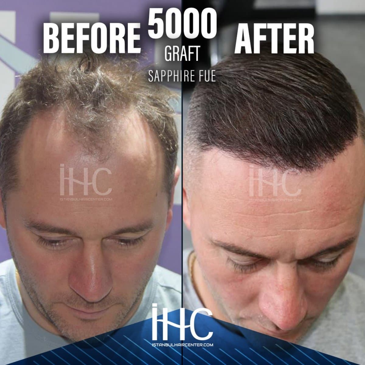 results of 5000 graft FUE hair transplant