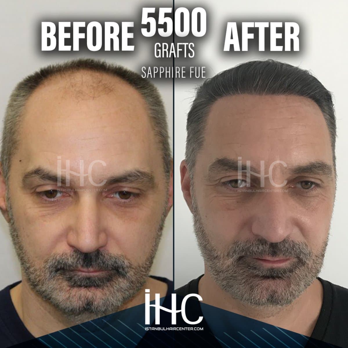 5500 grafts Sapphire FUE hair transplant